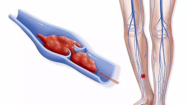 大腿静脉曲张和血栓的关系