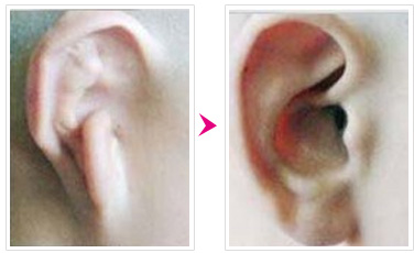 外耳再造手术最好的方法