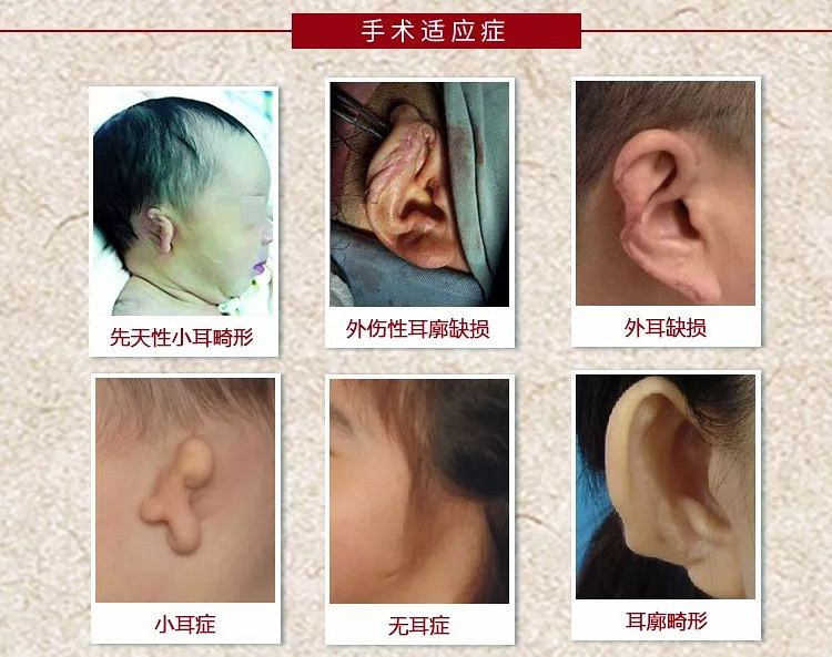 小耳畸形做手术治疗