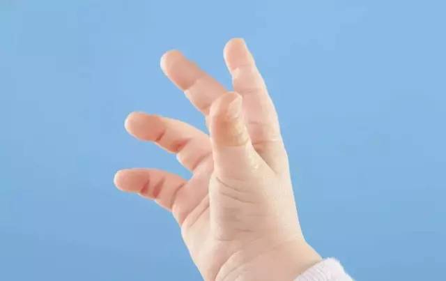 小儿左手小拇指发育不良