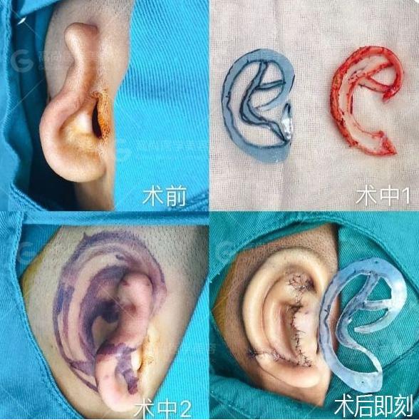耳廓畸形是怎样的