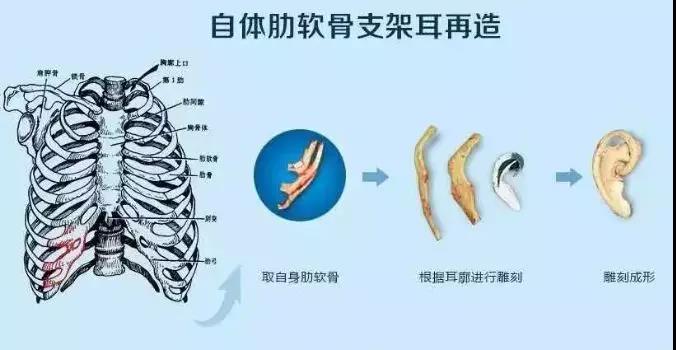 小耳畸形手术的最佳时间