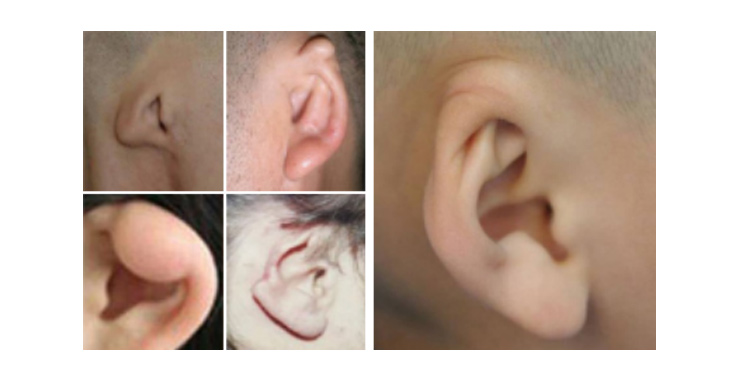 怎样判断耳廓畸形