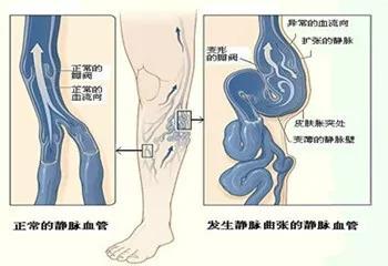 静脉曲张造成溃疡怎么治疗