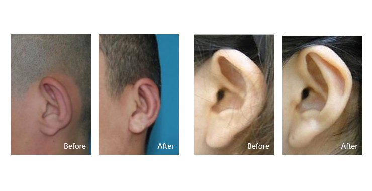外耳廓畸形可以矫正吗