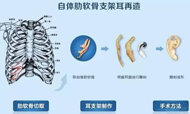 先天性耳前瘘管怎么预防