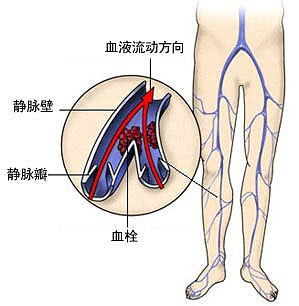 下肢静脉曲张并血栓的治疗