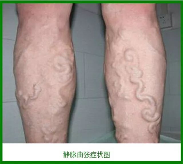 中医治疗老烂腿方法