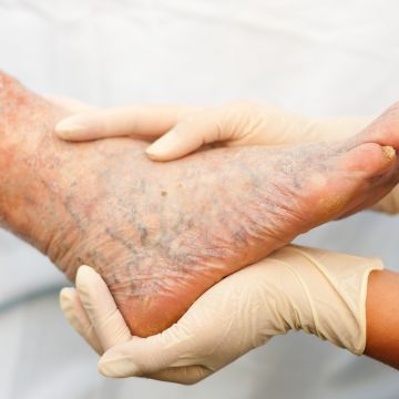 治疗老烂腿属于哪个科室