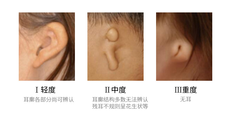 先天性小耳畸形分类症状