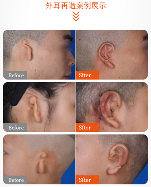 小耳畸形手术后缺点