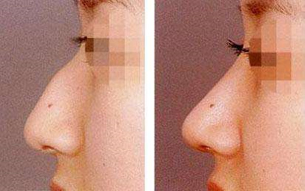 假体隆鼻分几种鼻型