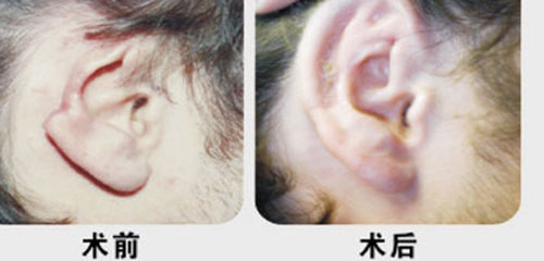 常见耳廓形态畸形类型有