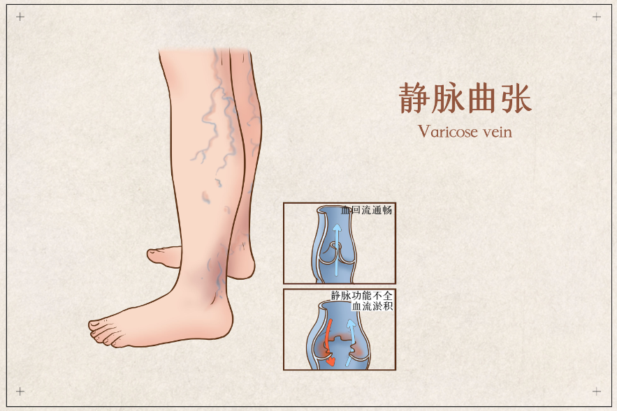 卧床老人的老烂腿治疗