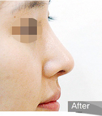 硅胶鼻假体取出变形