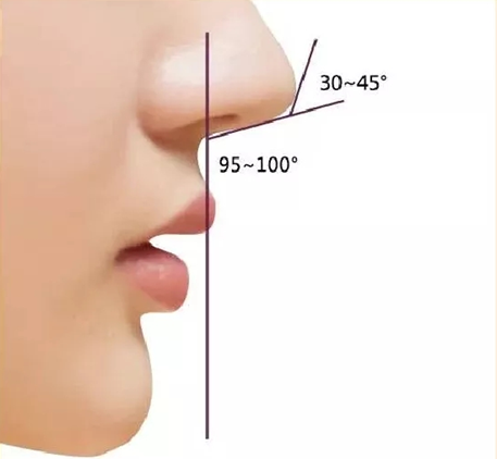 L型鼻假体有几种