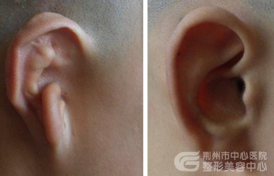 外耳再造术手术过程