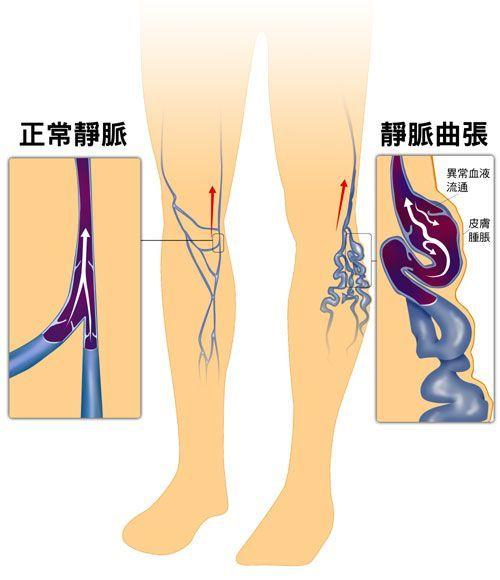 静脉曲张和血栓手术费用