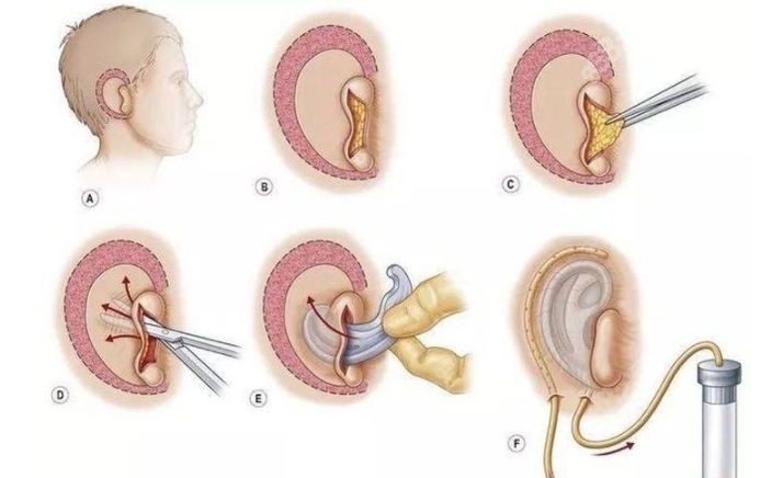 全耳畸形再造手术