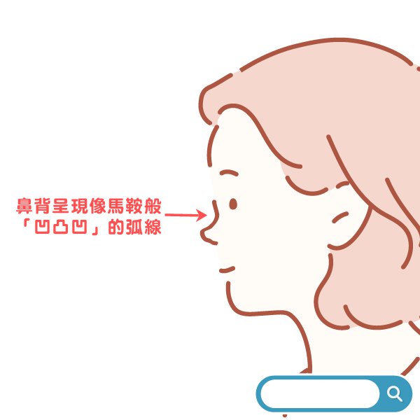 隆鼻感染预防