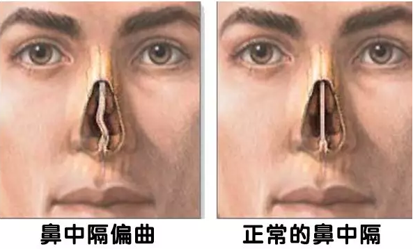 硅胶鼻整形修复