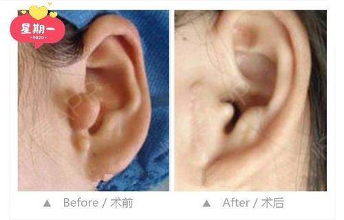 隐耳整形手术后护理