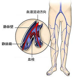 腿静脉曲张血栓是什么症状