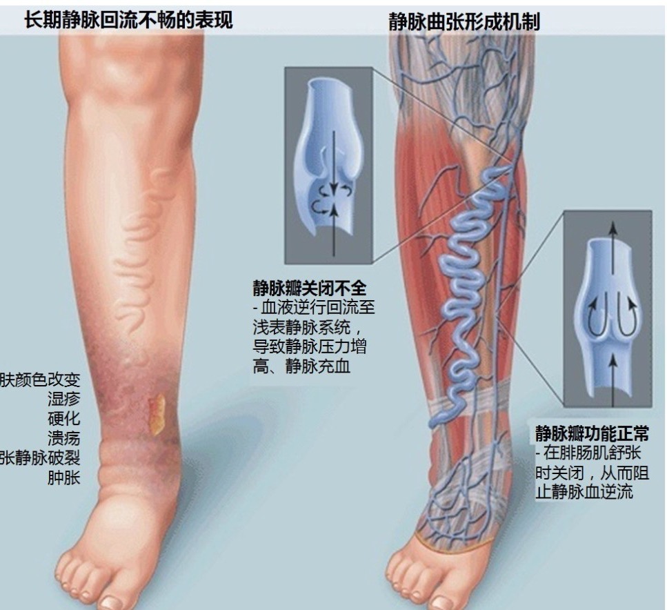 静脉曲张溃疡怎样治疗