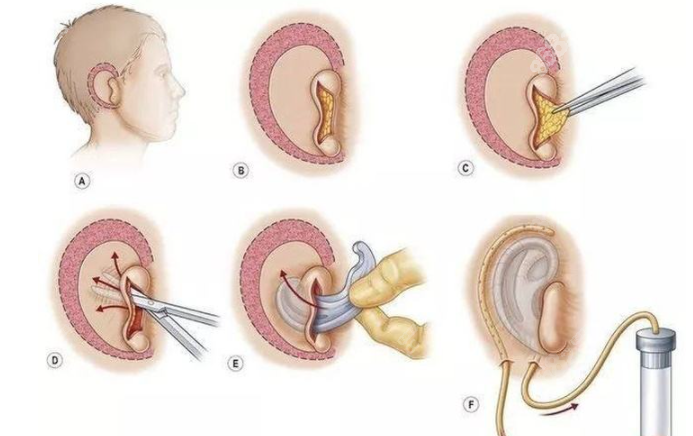 先天性小耳怎么办