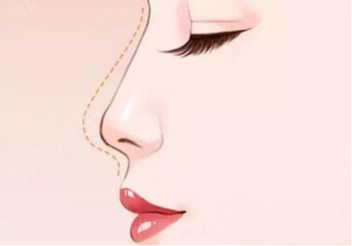 假体单纯隆鼻方法