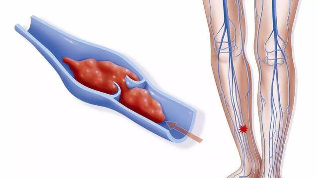 下肢静脉曲张伴血栓怎么治