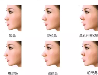 鼻假体分哪几种