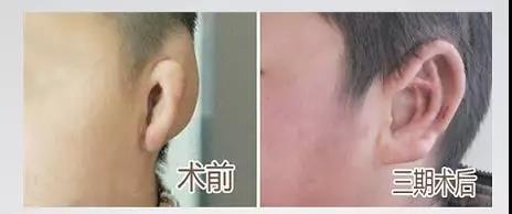耳再造修复手术
