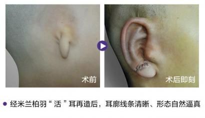 先天性耳前瘘管产生原因