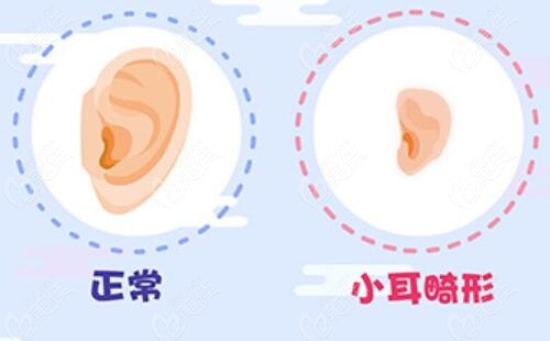 小耳畸形听力正常怎么办