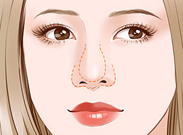L型鼻假体规格