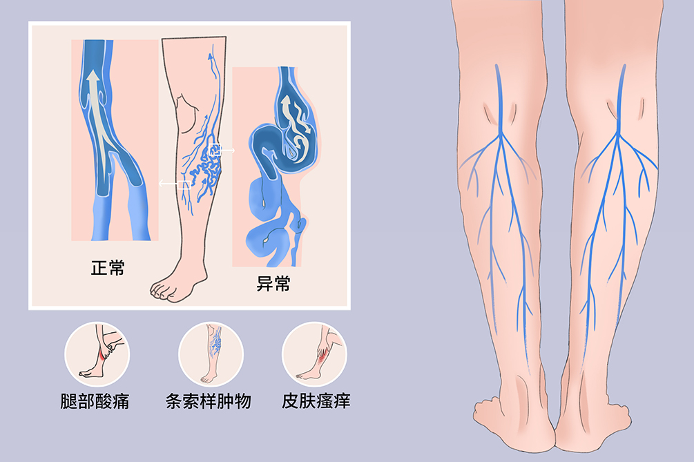 老烂腿溃烂痛吗