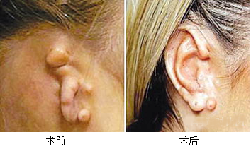 再造耳术后护理