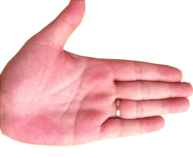 拇指发育不良手术重塑方法