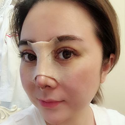 微创隆鼻手术恢复