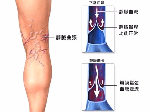 老烂腿如何手术