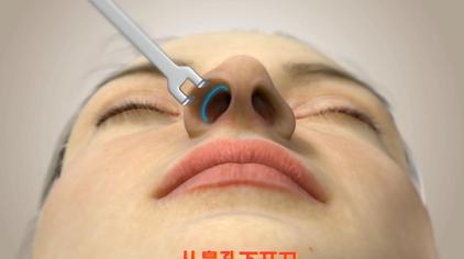 鼻子感染挛缩的修复方法