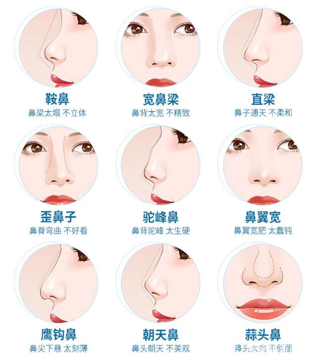 隆鼻子手术类型