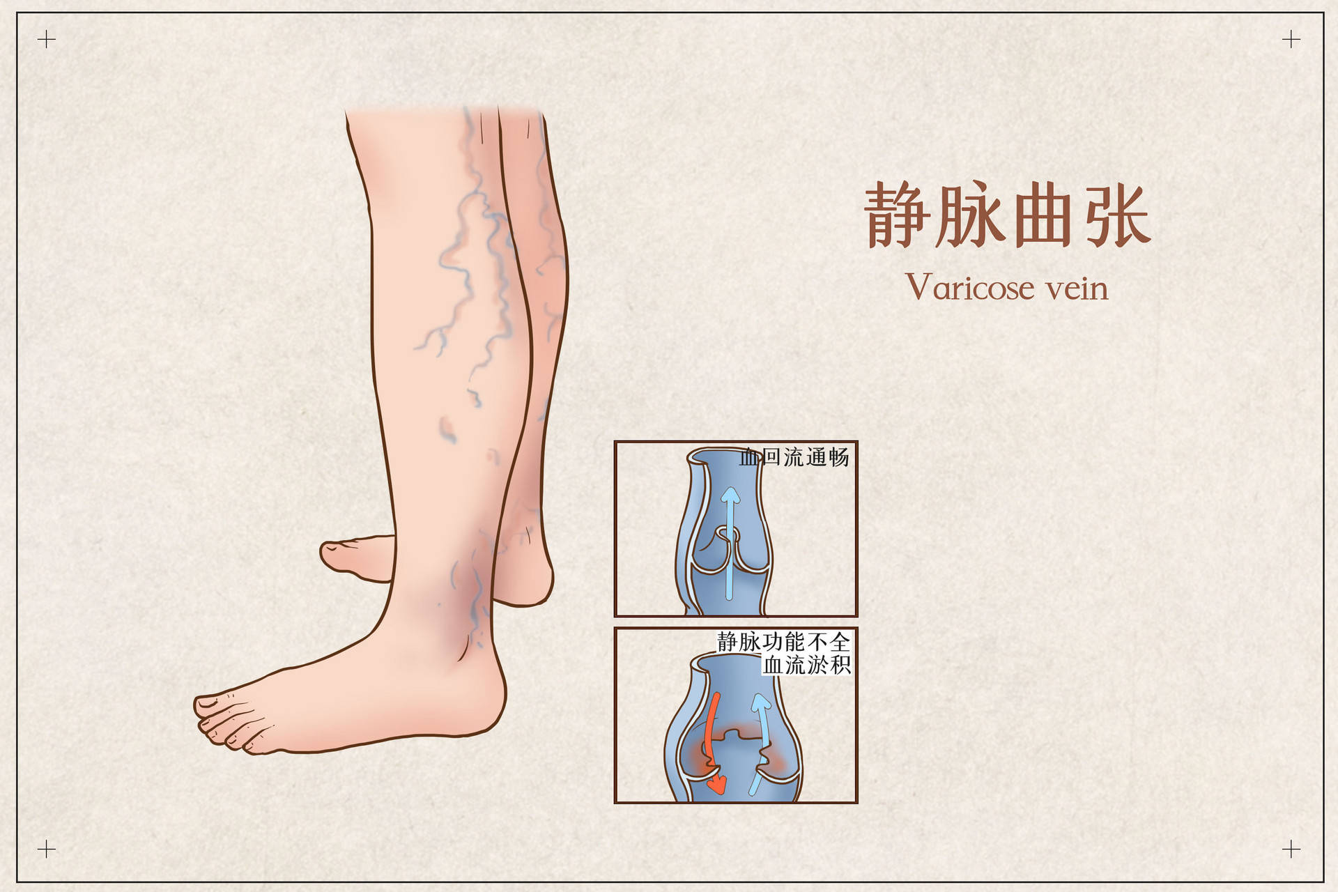 中医治疗老烂腿效果好吗