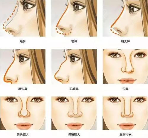 鼻假体分为哪种方式