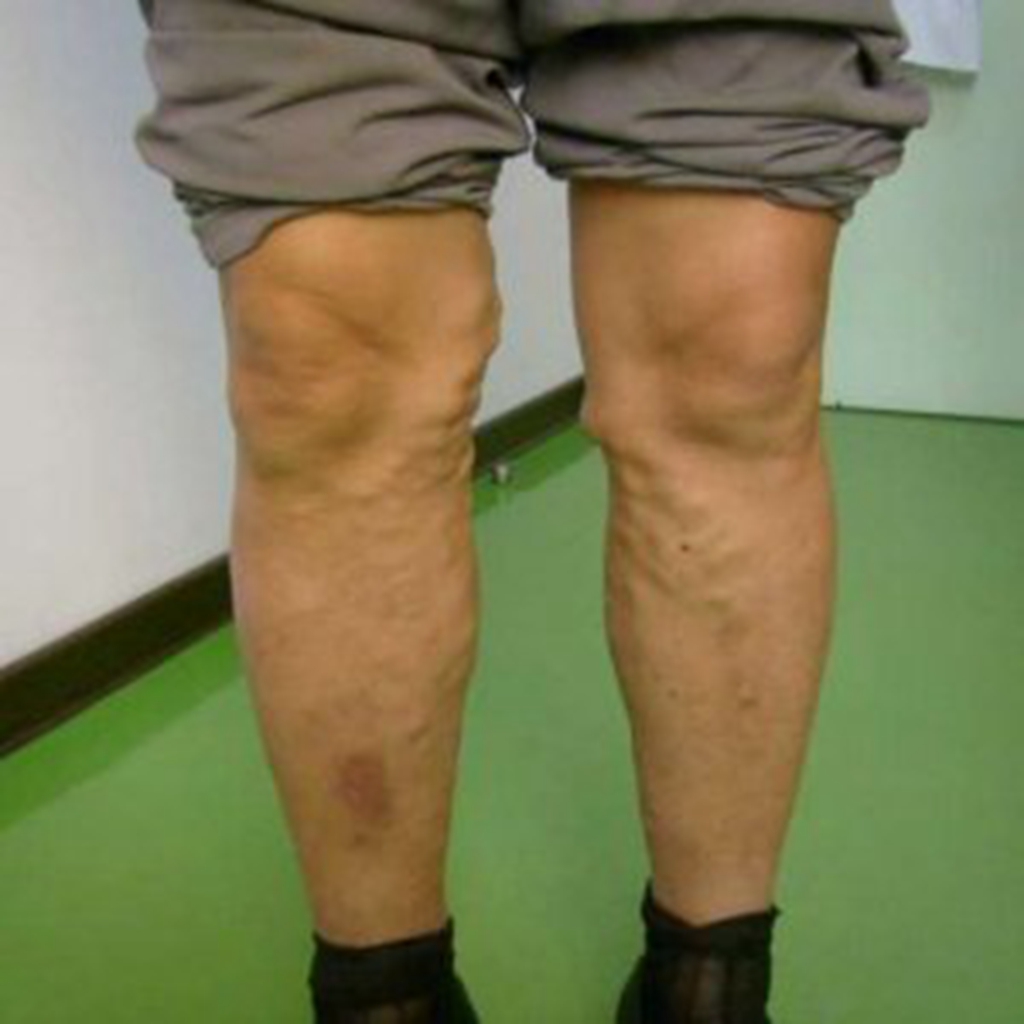 女性老烂腿治疗方法