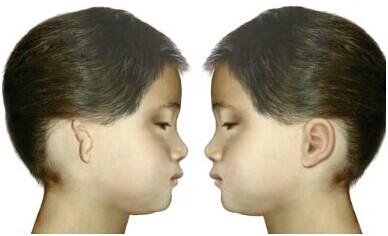 外耳廓畸形怎么描述