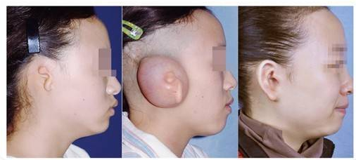 外耳再造手术的后遗症